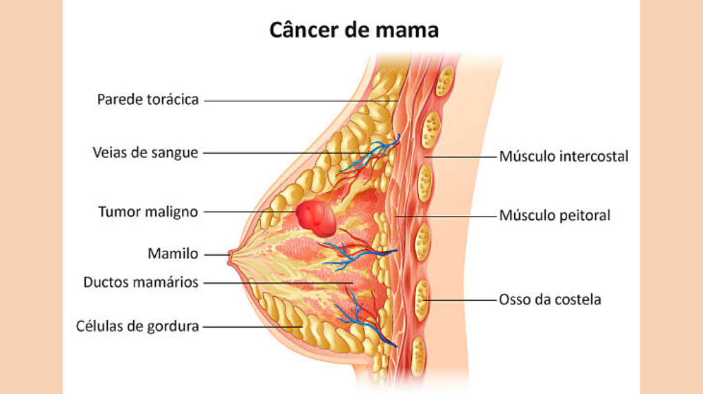 Câncer de mama feminino